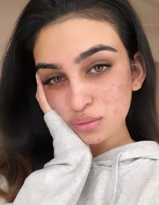 Ayesha Amir osvaja digitalni svet svojom borbom protiv akni i hejtera na društvenim mrežama