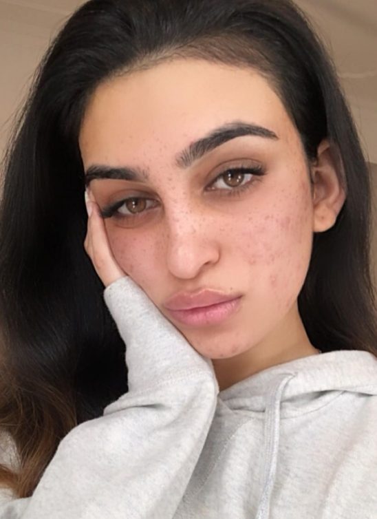 Ayesha Amir osvaja digitalni svet svojom borbom protiv akni i hejtera na društvenim mrežama